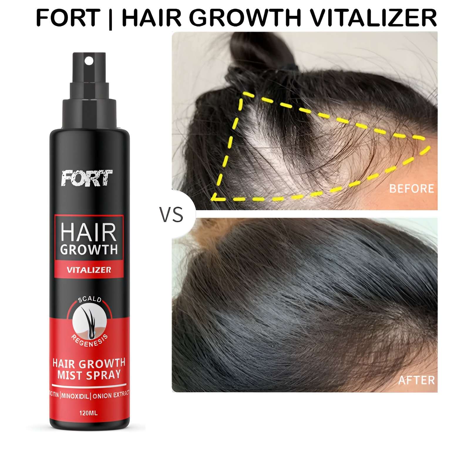 FORT Minoxidil Hair Growth Spray - Hair Tonic for Hair Care and Hair Growth